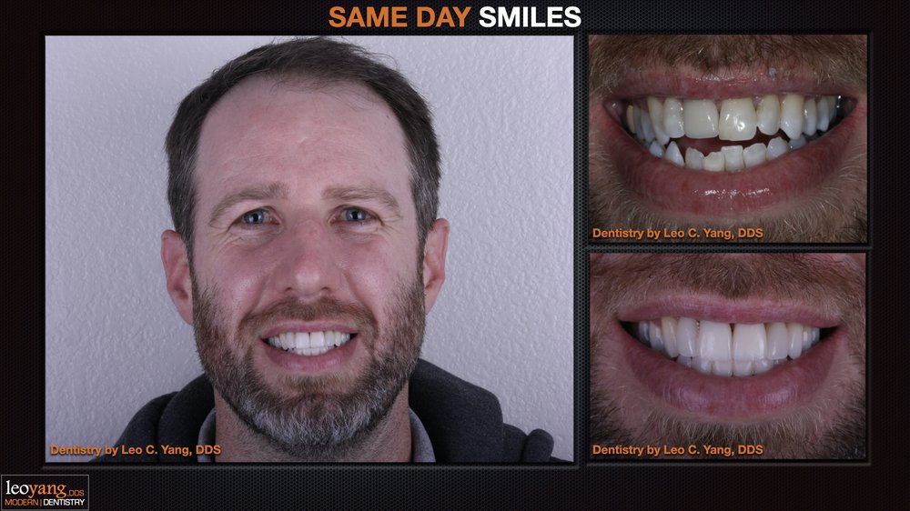 Same Day Smile Makeover
